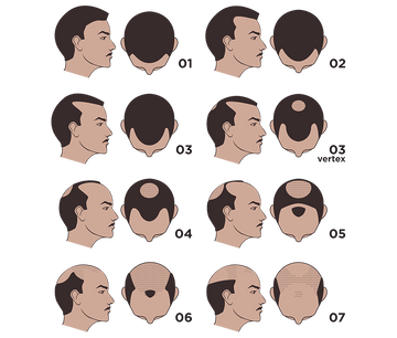 男性型脱毛症のステージ1から7を示すハミルトン・ノーウッド分類の図。