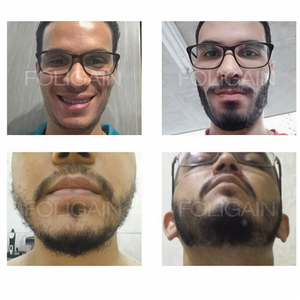 正面とあごの下から見たひげの生え具合を比較するビフォーアフター写真